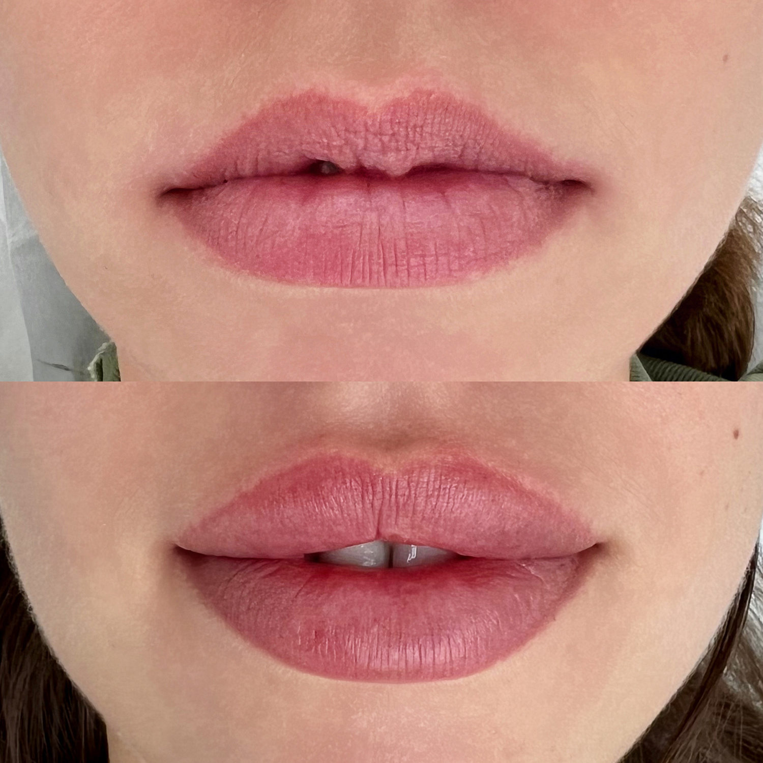 Контурная пластика губ препаратом ART FILLER LIPS в косметологической клинике Re:new