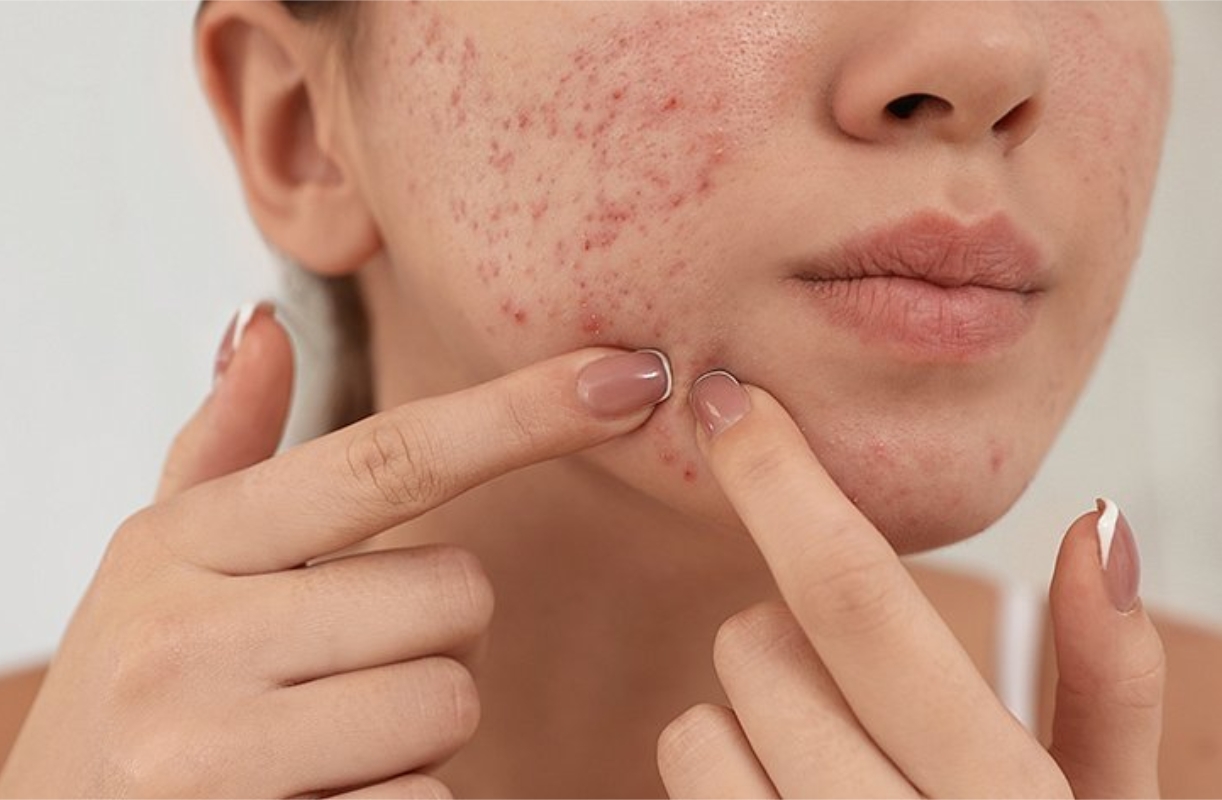 Как победить акне? Советы от эксперта