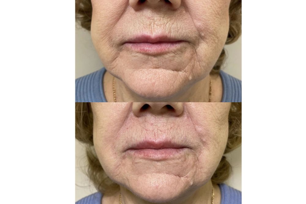 Эффект после бланширования морщин Эффект после бланширования морщин