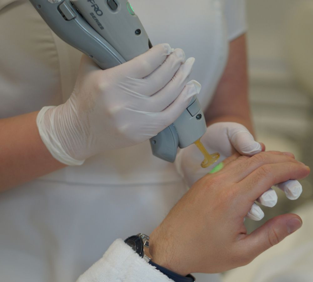 Мужская лазерная эпиляция на руках