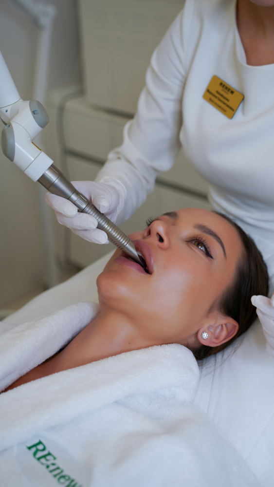 Фотона 4Д для омоложения лица фото