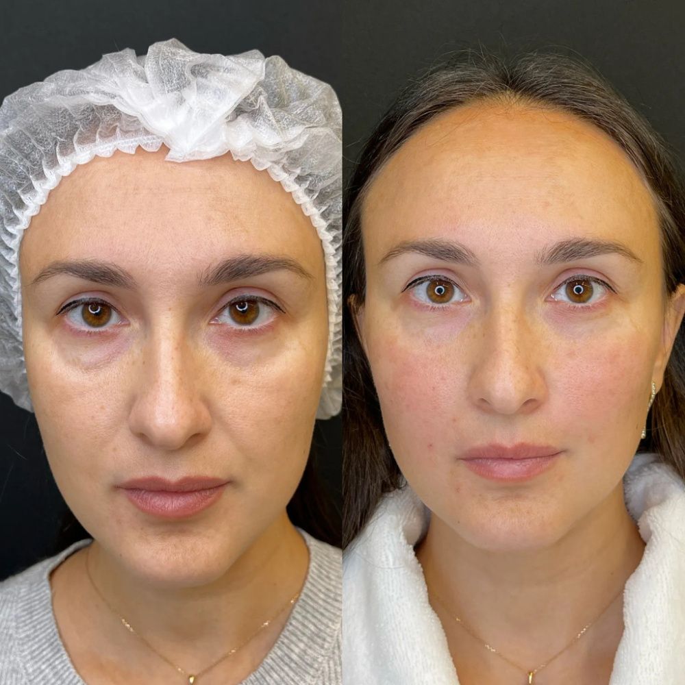 Эффект после контурной пластики средней трети лица