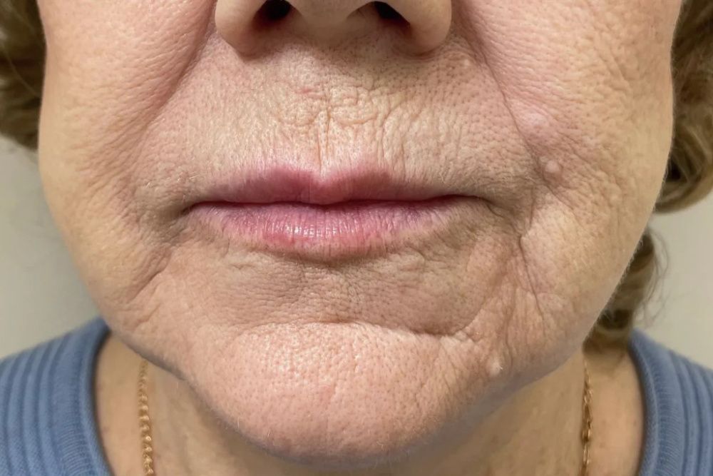 Бланширование морщин