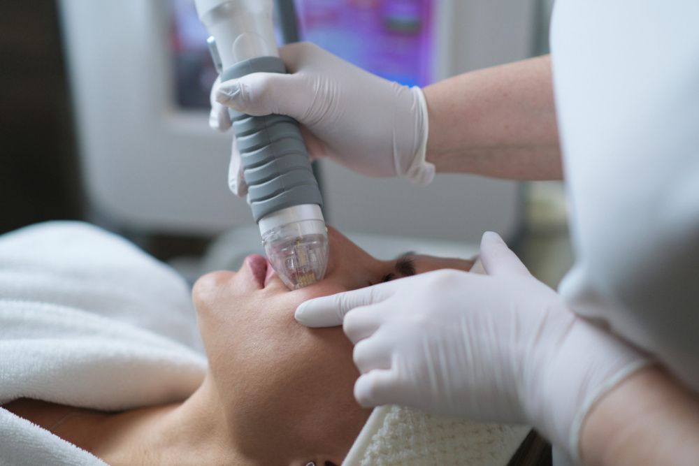 Микроигольчатый RF-лифтинг при носослезной борозде Микроигольчатый RF-лифтинг при носослезной борозде