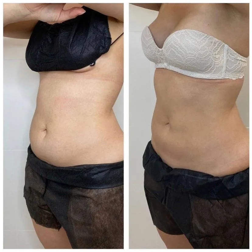 Coolsculpting by Zeltiq – криолиполиз в клинике Re:new в Москве